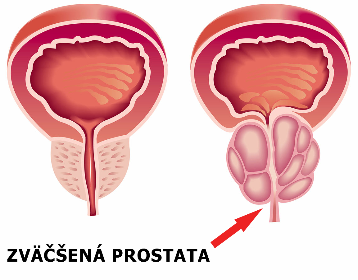 zväčšená prostata